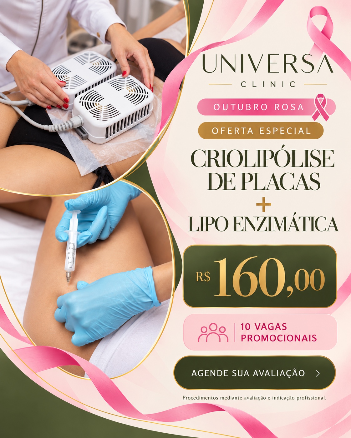 Criolipólise de Placas com Lipo Enzimática por R$ 160, com 10 vagas promocionais e indicação profissional.