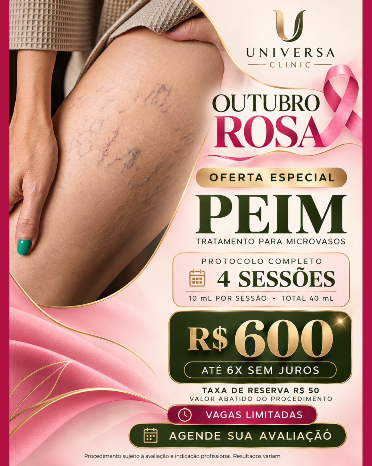 Oferta Outubro Rosa de PEIM para microvasos, protocolo com quatro sessões, 10 mL por sessão, por R$ 600.